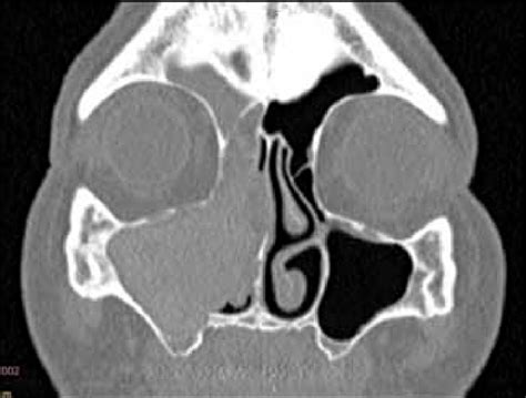 Ethmoid Sinus Ct Scan