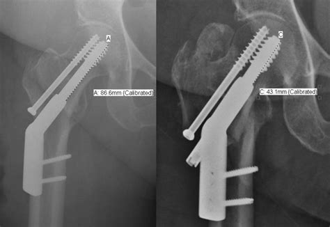 Cephalomedullary Nail Versus Sliding Hip Screw For Fixation Of Ao 31 A1