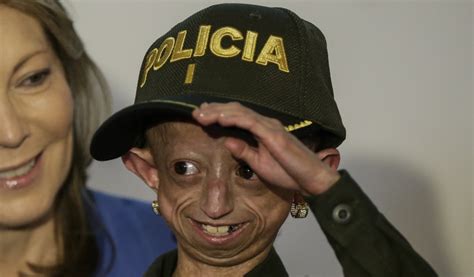 Karen Ordóñez Progeria Murió Karen Ordóñez La Niña Que Padecía De