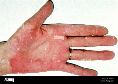 Erythema High Resolution Stock Photography And Images Alamy
