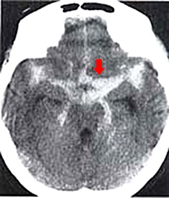 Axial slice of mri with all anatomical structures labeled. 脳卒中（脳梗塞・脳出血・くも膜下出血） | 対応疾患 | 流山 ...