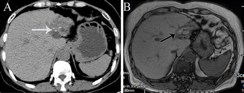 Preoperative Imaging Workup Of Left Intrahepatic Bile Duct Calculi And