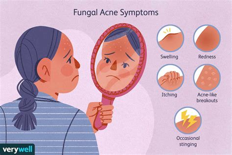 What Is Fungal Acne Symptoms Causes Treatment