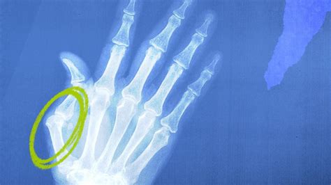 Thumb Arthritis Symptoms Causes And Treatment