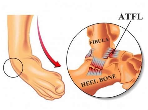 Grade 3 (severe) a complete tear of the ligament resulting in severe pain, extensive bleeding, and swelling. ATFL Injury - Dr. Sai Krishna B Naidu | Best Orthopaedic ...