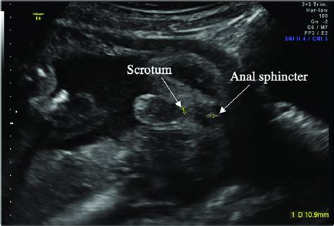Example Of The Perineum In A Male Fetus Demonstrating The Anogenital