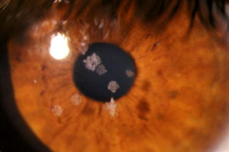Recognising Corneal Dystrophies Mivision
