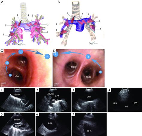 Illustrated Endobronchial And Sonographic Maps For Ebus Pulmonary
