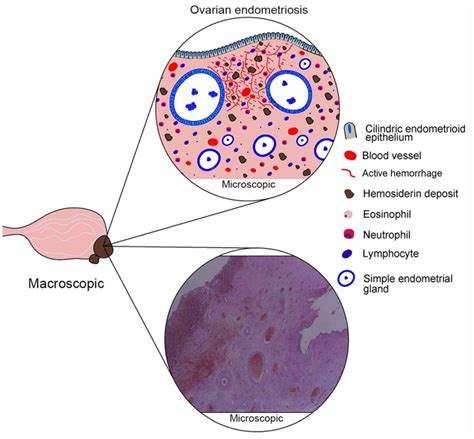 Ovarian Endometriosis A Precursor Of Ovarian Cancer Histological Aspects Gene Expression And