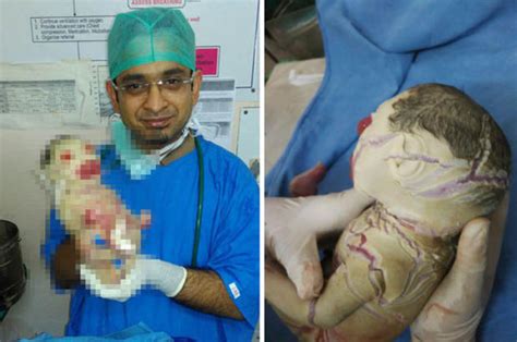 Worlds First Baby Born Without Skin Stuns Medical Experts