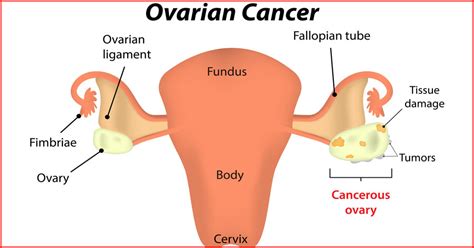 10 Warning Signs Of Ovarian Cancer Women Shouldnt Ignore Page 3 Of 6