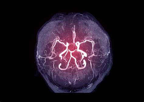 Intracranial Atherosclerosis Finding On Mra Linked To Stroke Mdedge