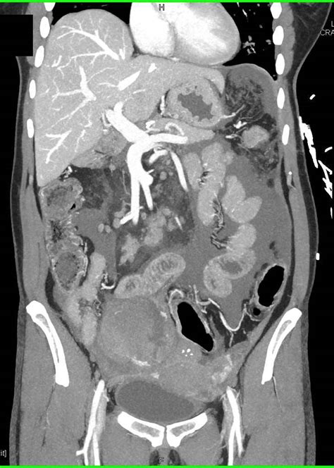 Carcinomatosis With Cavitary Lung Metastases Due To Ovarian Cancer Ob