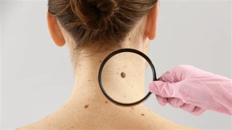 Moles On Each Location Of Your Body Explained