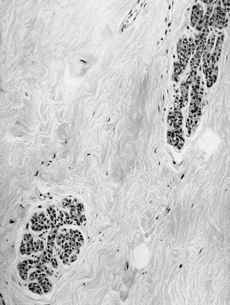 Pathology Outlines Lobular Carcinoma In Situ Lcis