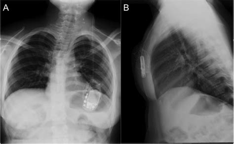 AP A And Lateral B Chest X Ray Performed On Presentation Showing