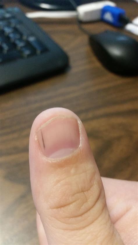 I have psoriasis and it affects my nails; Thin black line in thumb nail. How concerned should I be ...