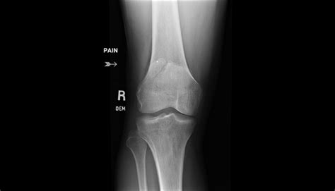 Ortho Dx Knee Pain Following Injury Clinical Advisor