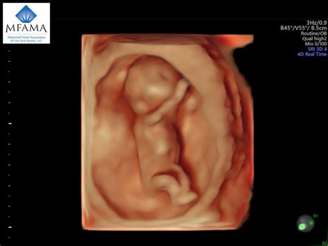 3d 4d ultrasound maternal fetal associates of the mid atlantic