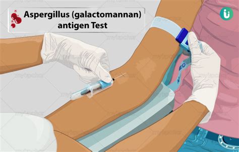 Aspergillus Galactomannan Antigen Test Procedure Purpose Results