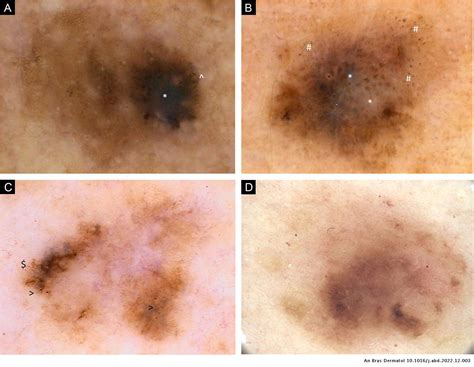 Patients With Three Or More Primary Melanomas Clinical Epidemiological