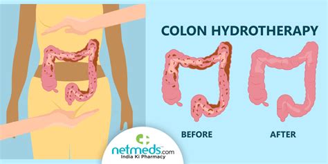 Colonic Irrigation What Is It Will It Eliminate Body Toxins
