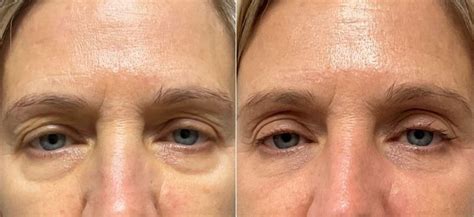 Before And After Radiance Skincare And Laser Medspa Wheaton Il