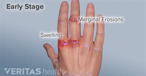 Swollen Knuckle Finger 15 Causes Of Swollen Fingers