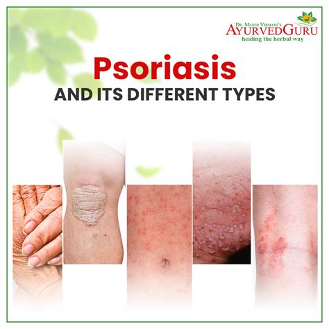 Aggregate More Than 146 Nail Psoriasis Treatment In Ayurveda Latest
