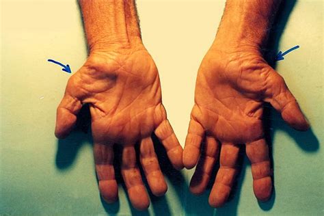 Upper Limb Nerve Injuries Carpal Tunnel Syndrome Claw Hand