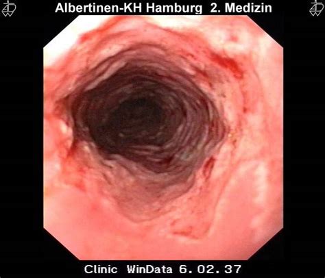Grayish white pseudomembrane or plaque in mid to distal esophagus. CMV-esophagitis - DocCheck Pictures