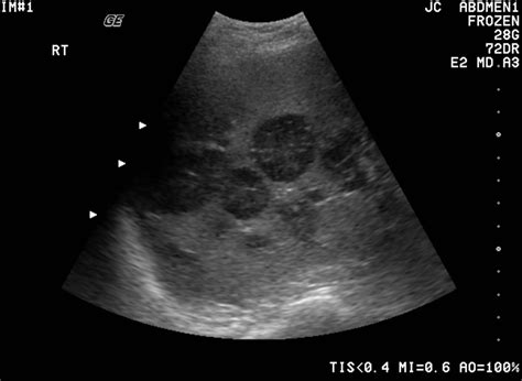 Pancreatic cancer arises when cells in the pancreas, a glandular organ behind the stomach, begin to multiply out of control and form a mass. Can Ultrasound Detect Cancer? | New Health Advisor