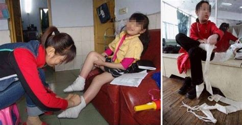 Foot Binding Sees Revival In China Tears In Heaven Amputee Lady Binding