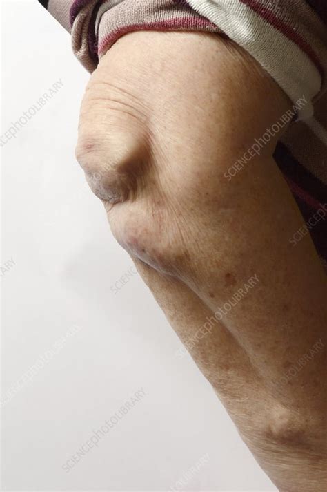 Rheumatoid Arthritis In The Elbow Stock Image C0166937 Science