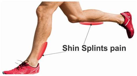 Shin Splints Medial Tibial Stress Syndrome Mtss Stirling Massage