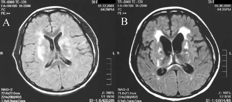 Rapid Progressive Cerebral Atrophy In Systemic Lupus Erythematosus