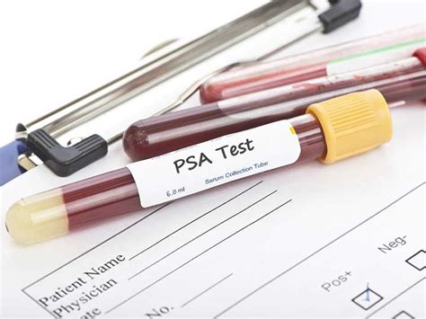Fine Tuning Psa Test Boosts Prediction Of Aggressive Ca Medpage Today