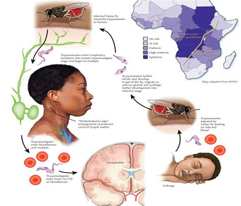 Sleeping Sickness Causes Symptoms Treatment Diagnosis And