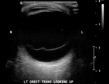 Posterior Vitreous Detachment Radiology Case Radiopaedia Org