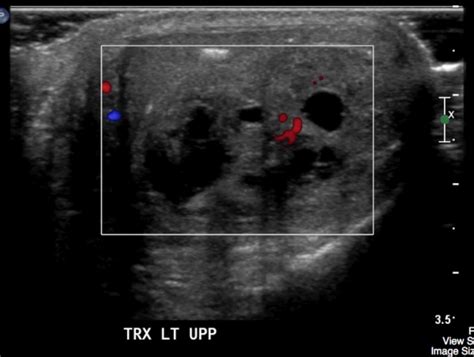 Testicular Tumour Undergraduate Diagnostic Imaging Fundamentals