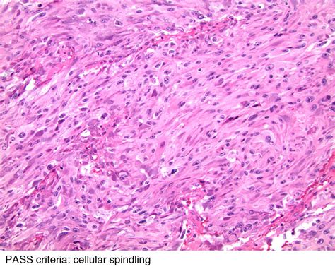 Pathology Outlines Features To Report Pheochromocytoma Paraganglioma