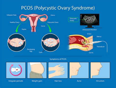 Polycystic Ovaries Treatment Pregnancy
