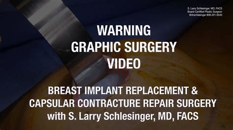 Breast Implant Replacement Capsular Contracture Surgery Youtube