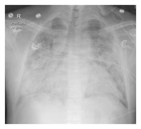 Chest X Ray Ap View Showing Extensive Bilateral Perihilar And Basal