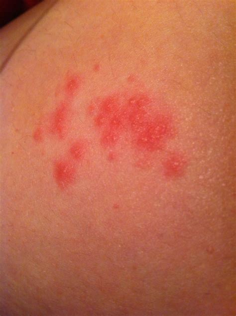 I Have An Area Of Red Raised Spots And Rash On Upper Left Leg