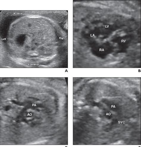 Ultrasound of fetal cardiac anomalies. Figure 4 from Ultrasound of fetal cardiac anomalies ...