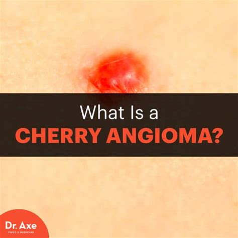 Cherry Angioma Risk Factors Symptoms And Natural Treatments Dr Axe