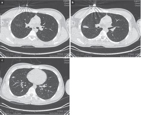 Pulmonary Laceration And Contusion In A Young Male Patient Due To A
