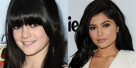 Kylie Jenner Plastic Surgery Timeline Before And After Pictures