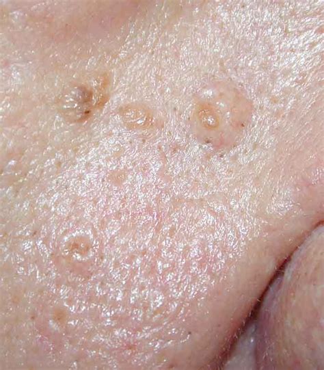 What Are The Causes And Treatments For Sebaceous Hyperplasia